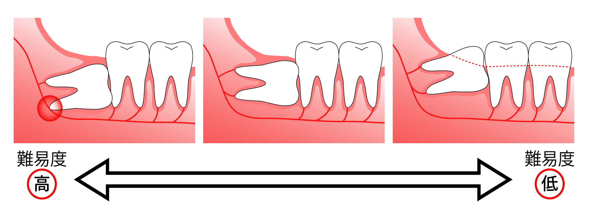 難易度の高い抜歯も対応可能