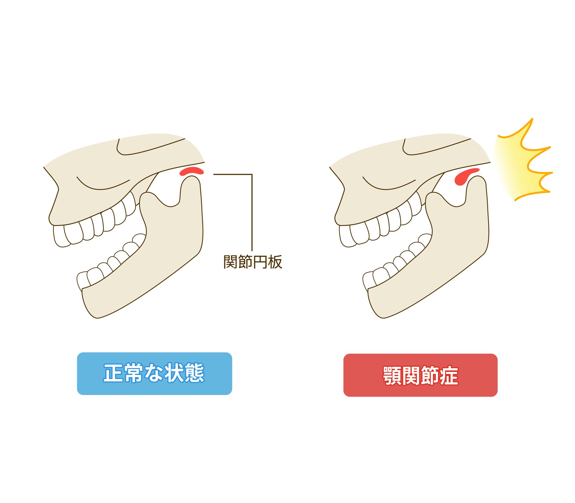 顎関節症とは？